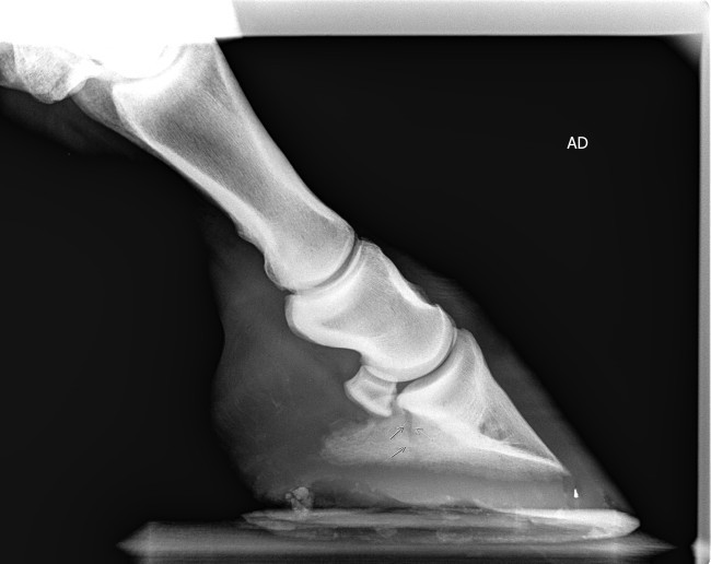 Fracture antrieur droit