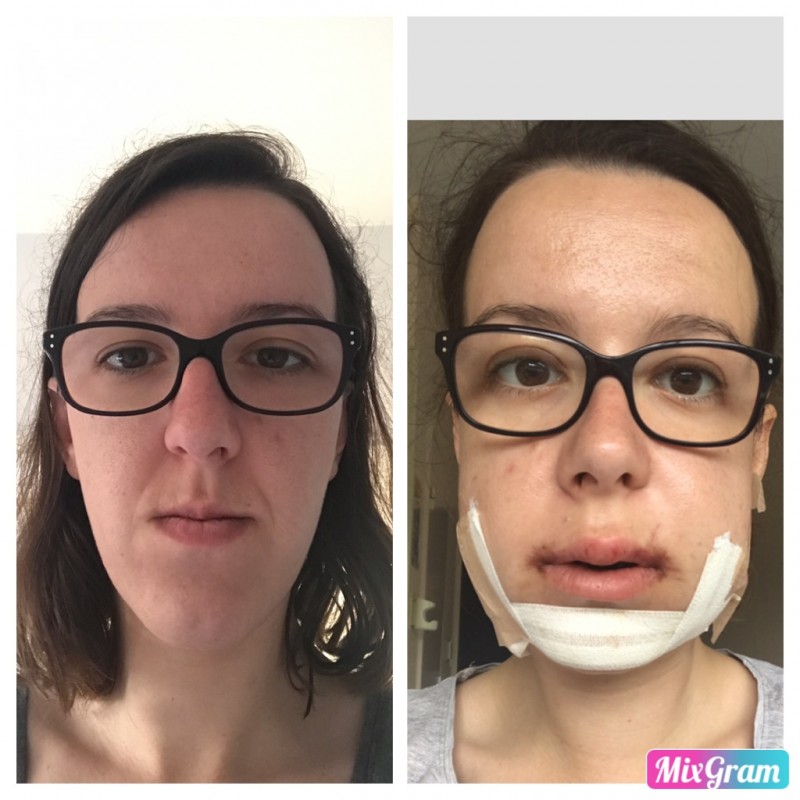 Orthodontie + opération mâchoire chez l